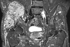Metastase eines NCC